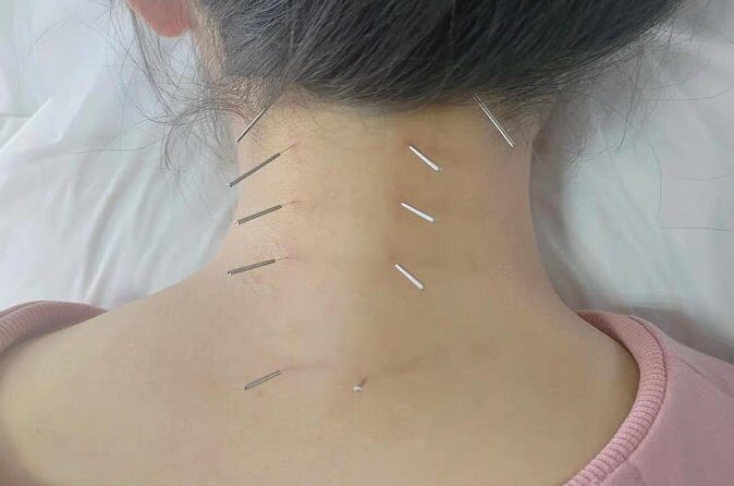 Acupuncture and Suction Cups Session at the Hospital - FAQ