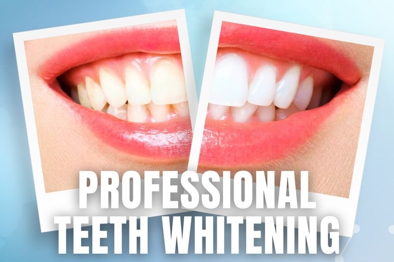 iSmile Professional Teeth Whitening Experience in Batam - The useful details at a glance