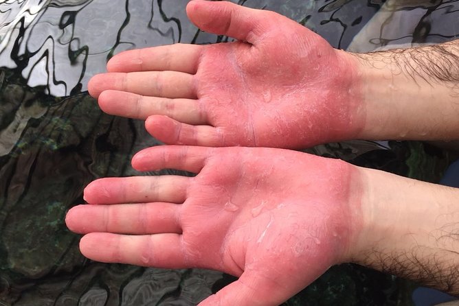 Psoriasis Fish Treatment by Garra Rufa Dr Fish in Turkey for 14 Days - Pricing and Booking Details