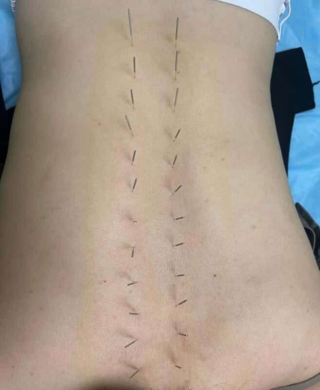 Traditional Chinese Medicine AcupunctureCupping Experience - The Itinerary and What to Expect  