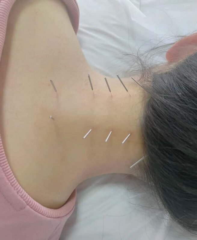 Traditional Chinese Medicine AcupunctureCupping Experience - The Sum Up  